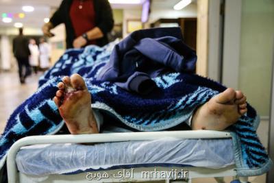 بیماران سوخته تریبون ندارند