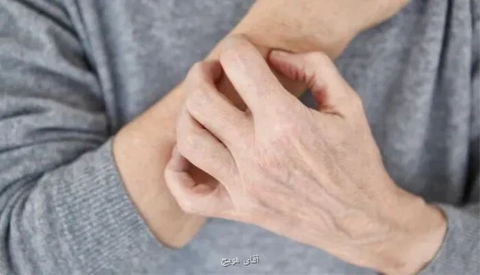 نشانه های پوستی که از بیماری خبر می دهند